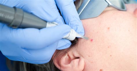 Eliminación de verruga facial con láser en clínica dermatológica de Madrid