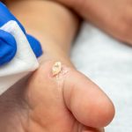 servicios-eliminacion-verrugas servicios-eliminacion-verrugas