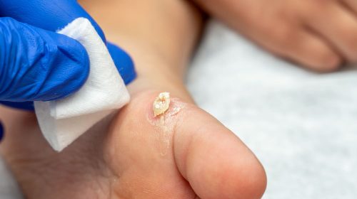 servicios-eliminacion-verrugas servicios-eliminacion-verrugas